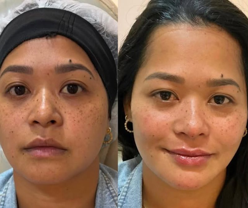 Antes e depois de harmonização facial com resultado natural na Clínica Aurielis