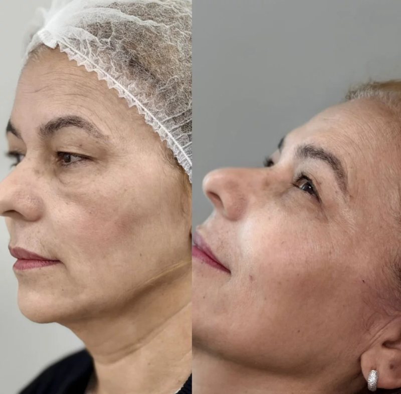 Resultado natural de harmonização facial — antes e depois de paciente da Clínica Aurielis