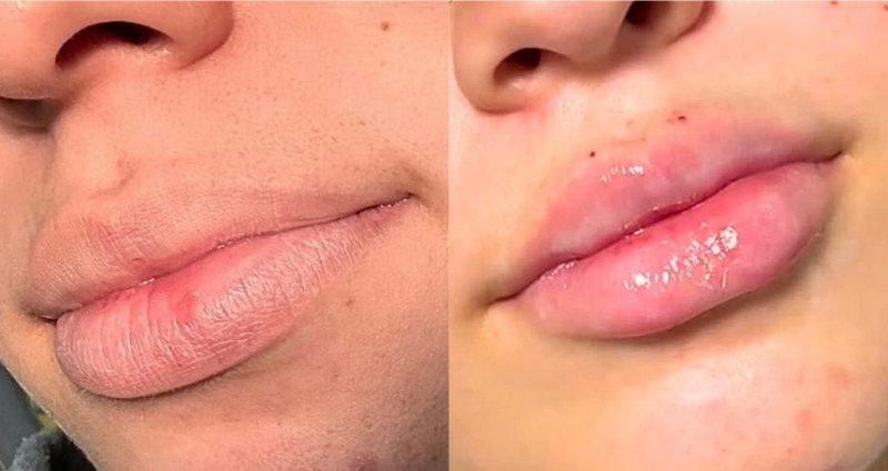 Antes e depois de preenchimento labial com ácido hialurônico na Clínica Aurielis