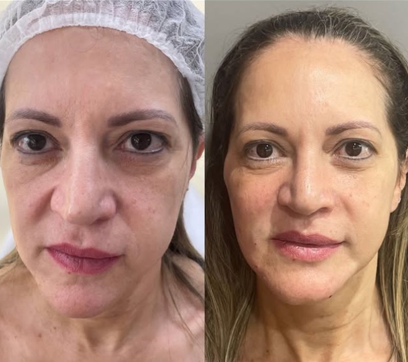 Antes e depois de toxina botulínica para linhas de expressão na Clínica Aurielis